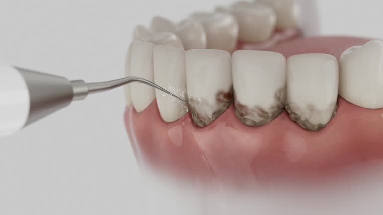 Trusted Wisdom Tooth Removal service in Jeffersonville, KY - Dentist Open Now